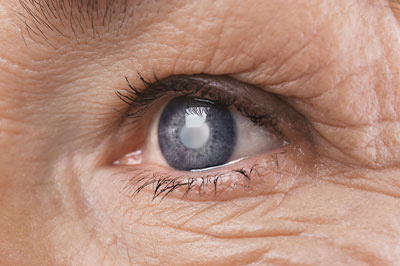 The image shows a close-up of an elderly person s eye, with the individual s skin and the surrounding area visible.